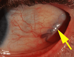 Sclera photo — coronary artery obstruction